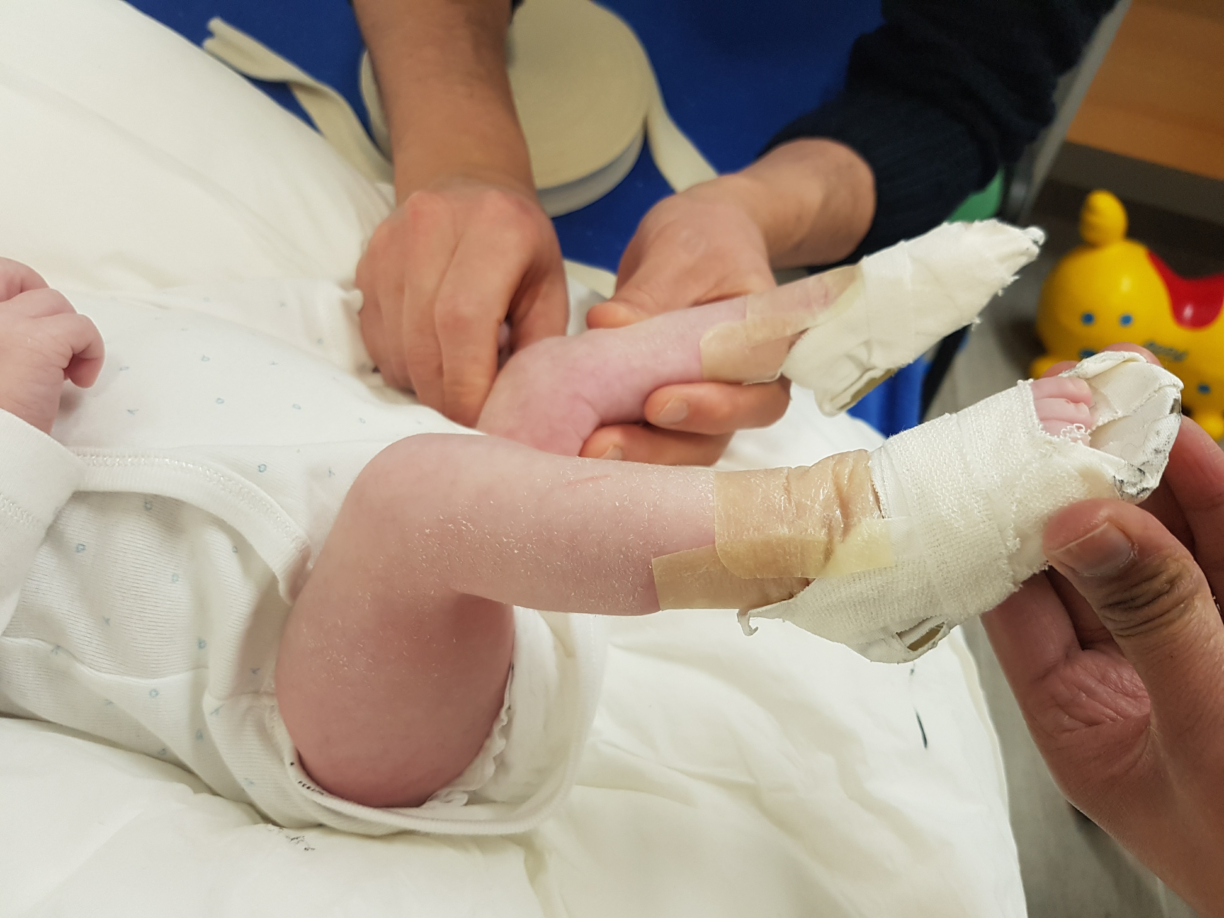 Application of a long-leg (above-knee) plaster cast in the Ponseti method, the foot held abducted around the talar head. (Orthopediatrie, Wikimedia Commons; CC BY-SA 4.0.)