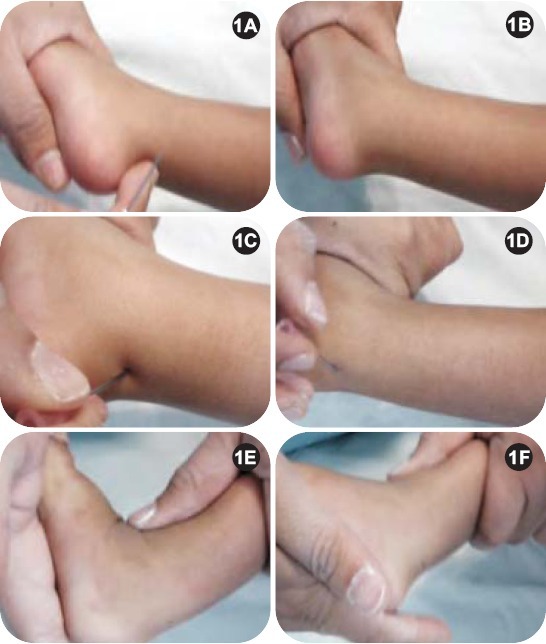 Percutaneous needle tenotomy of the tendo Achilles in clubfoot (six-panel clinical series): the needle/blade at the medial heel, then the foot dorsiflexing as correction is achieved. (Patwardhan et al., J Orthop Case Rep 2012;2(1):35; CC BY-NC-SA 3.0 - non-commercial.)