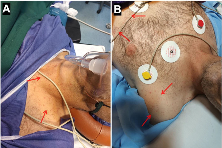 Figure 11. The petechial rash of fat embolism syndrome over the chest and axilla. From a case report (2024), PMC11625105, CC BY 4.0.