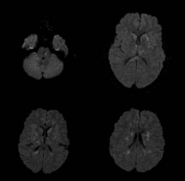 Figure 12. Cerebral fat embolism on diffusion-weighted MRI: scattered punctate hyperintensities, the “starfield” pattern. From Parizel et al. (2009), Cases Journal 2:212, PMC2783161, CC BY 2.0.