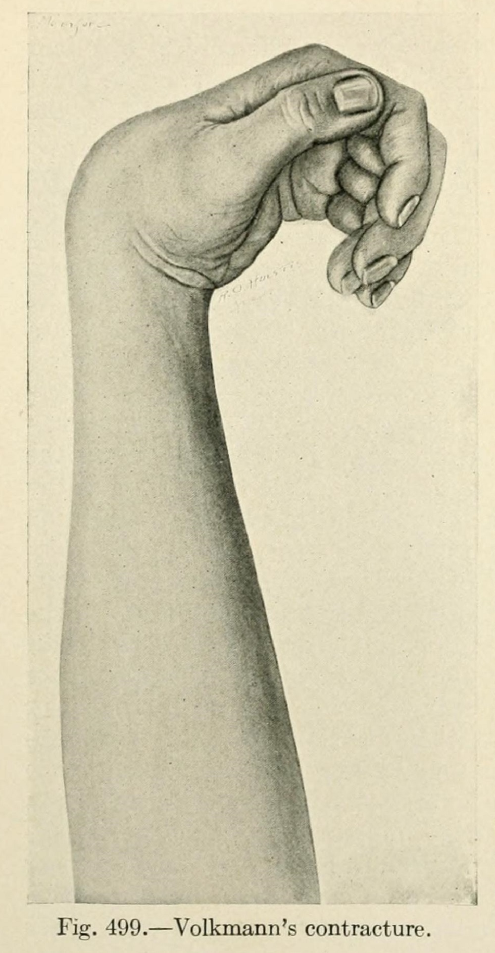 Figure 1. Volkmann ischaemic contracture of the forearm and hand, the end-result of untreated compartment ischaemia. Source: Mumford, The Practice of Surgery (1910), public domain, via Wikimedia Commons / Internet Archive.