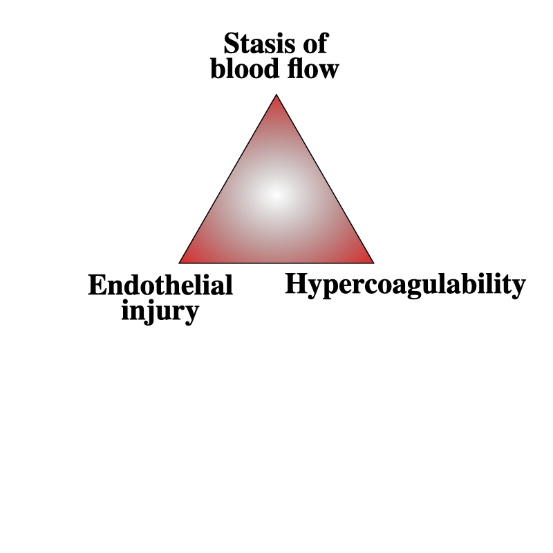 Figure 3. Virchow’s triad: venous stasis, endothelial injury and hypercoagulability, every limb of which is aggravated by trauma. Source: Rudolf.hellmuth, via Wikimedia Commons, CC BY-SA 3.0.
