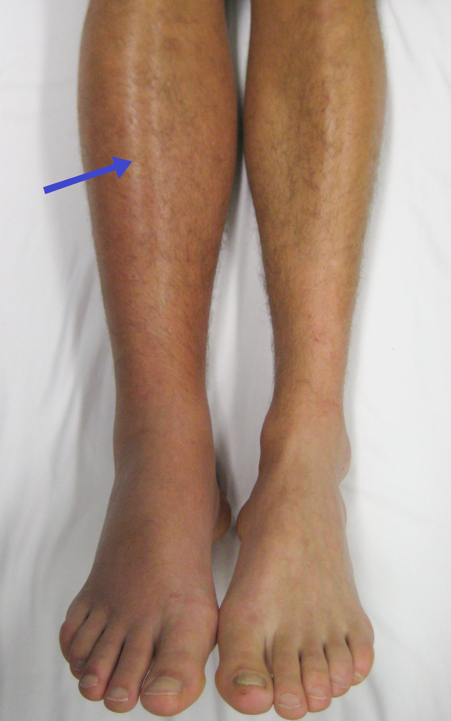 Figure 4. Deep vein thrombosis of the right leg: a swollen, erythematous calf. Source: James Heilman, MD, via Wikimedia Commons, CC BY-SA 3.0.