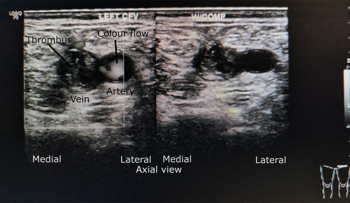 Figure 5. Compression duplex ultrasound of the common femoral vein, the standard test for DVT: echogenic thrombus filling the vein, which remains non-compressible. Source: Cerevisae, via Wikimedia Commons, CC BY-SA 4.0.