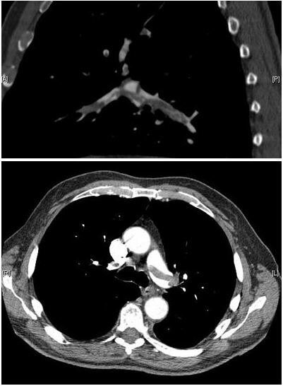 Figure 6. Pulmonary embolism on CT pulmonary angiography, the gold standard for PE: a saddle embolus straddling the pulmonary-artery bifurcation. Source: Myat & Ahsan, Thrombosis Journal 2007, via Wikimedia Commons, CC BY 2.0.