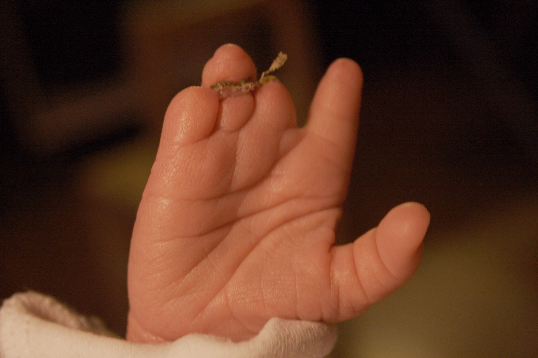 Amniotic-band sequence in a newborn hand: the fingertips are distally truncated (intrauterine congenital amputation). (Moscowmom, Wikimedia Commons; public domain.)