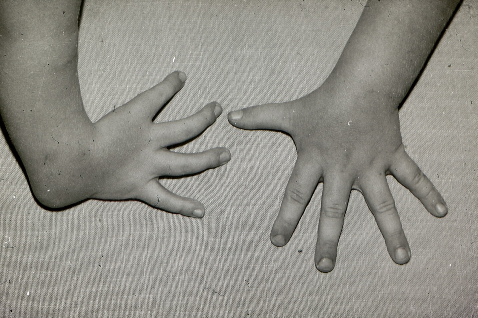 Radial longitudinal deficiency: the affected hand (image left) has four digits with an absent thumb; the other hand is normal. (Mehlauge, Wikimedia Commons; CC BY-SA 3.0.)