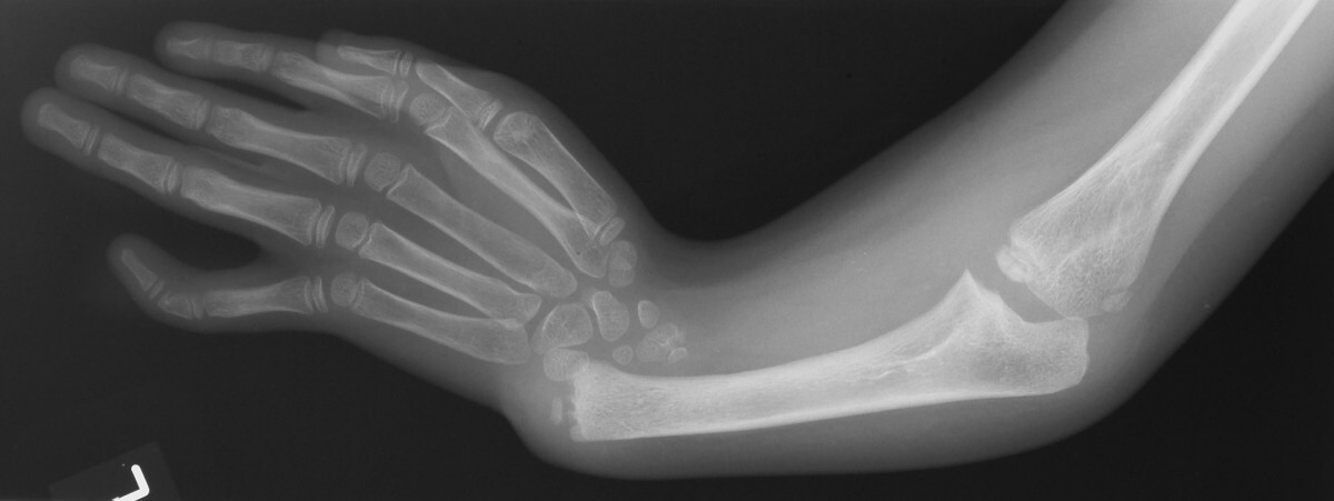 Radiograph of radial club hand (TAR syndrome): the radius is absent, the single ulna is bowed, and the hand is radially deviated off the forearm. (Ahmad R, BMC Nephrol 2007; CC BY 2.0.)