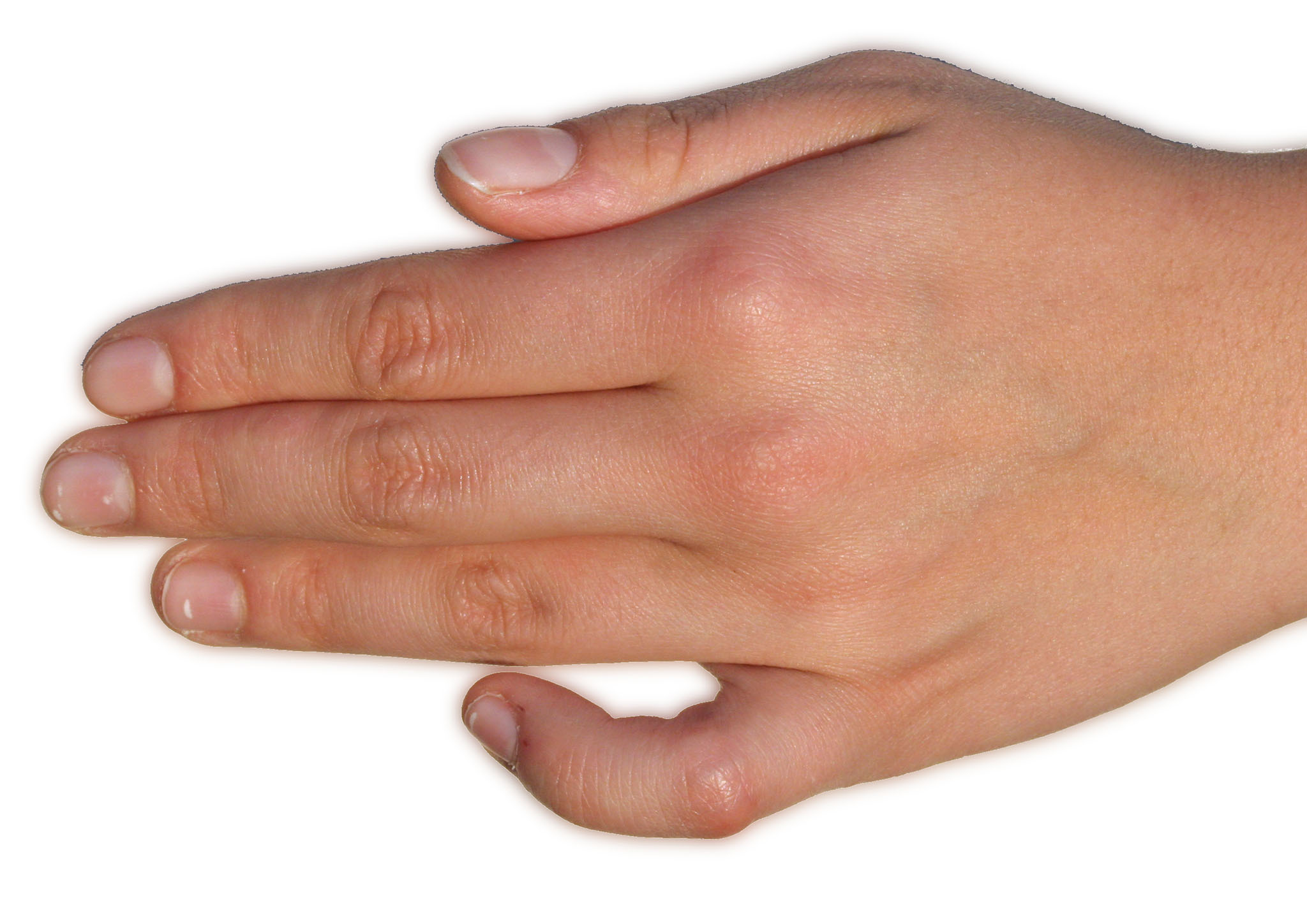 Camptodactyly: a fixed flexion contracture of the little finger at the PIP joint while the other digits extend. (Armin Kübelbeck, Wikimedia Commons; CC BY-SA 3.0.)