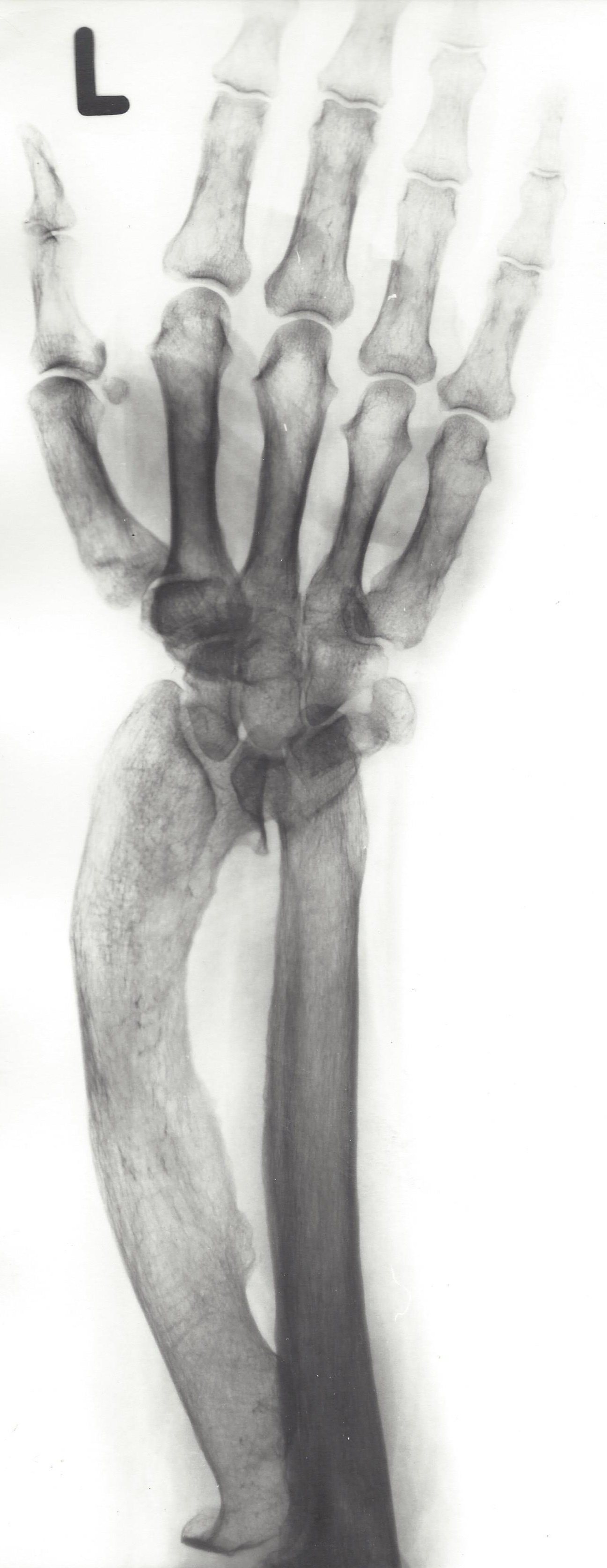 Radiograph of Madelung deformity: increased ulnar and volar tilt of the distal radius with a dorsally prominent ulna and the carpus wedged into the radioulnar gap. (Wikimedia Commons; CC BY-SA 3.0.)
