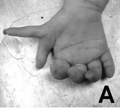 Preaxial polydactyly (thumb duplication) of an infant hand. (Tantbirojn P et al., J Med Case Rep, via Wikimedia Commons; CC BY 2.0.)