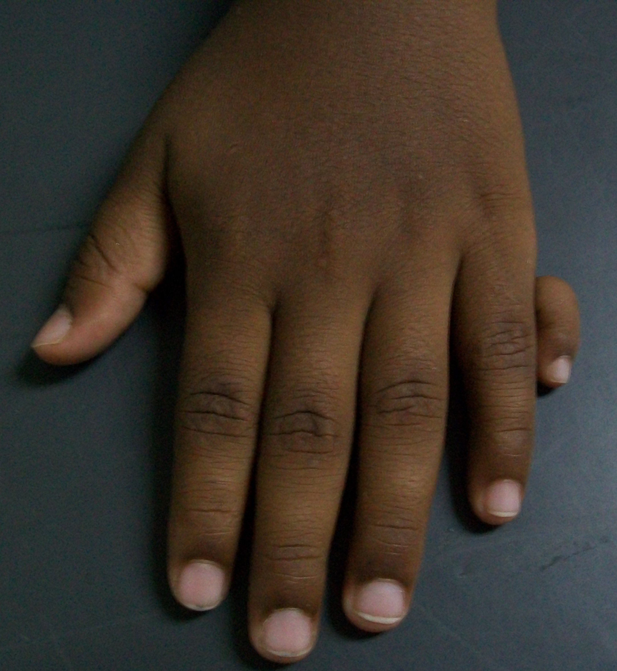Postaxial polydactyly: a supernumerary digit on the ulnar (small-finger) border of a child’s hand. (Bobjgalindo, Wikimedia Commons; CC BY-SA 4.0.)