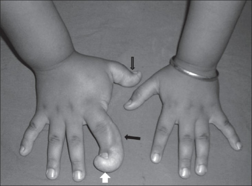 Macrodactyly of the hand (macrodystrophia lipomatosa): grossly enlarged digits (arrows). (Singla V et al., Indian J Radiol Imaging 2008; CC BY, PMC2747455.)
