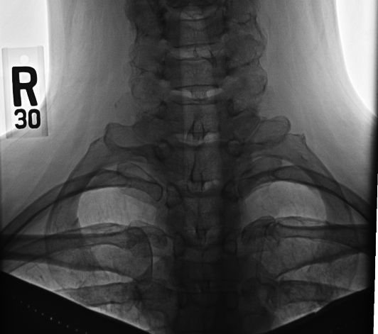 Cervical ribs. Antero-posterior radiograph showing bilateral, symmetric supernumerary ribs arising from the C7 transverse processes - the bony lesion that can narrow the thoracic outlet. Huntsville Hospital Imaging, Wikimedia Commons (public domain).