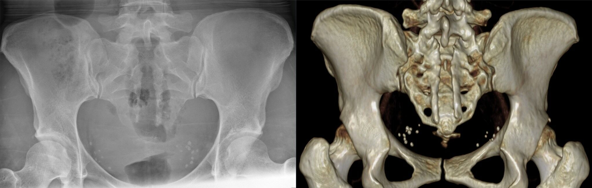 Bony spina bifida (sacral dysraphism). Antero-posterior radiograph (left) and three-dimensional CT reconstruction (right) showing long-segment failure of closure of the posterior sacral arches. Hellerhoff, Wikimedia Commons (CC BY-SA 4.0).