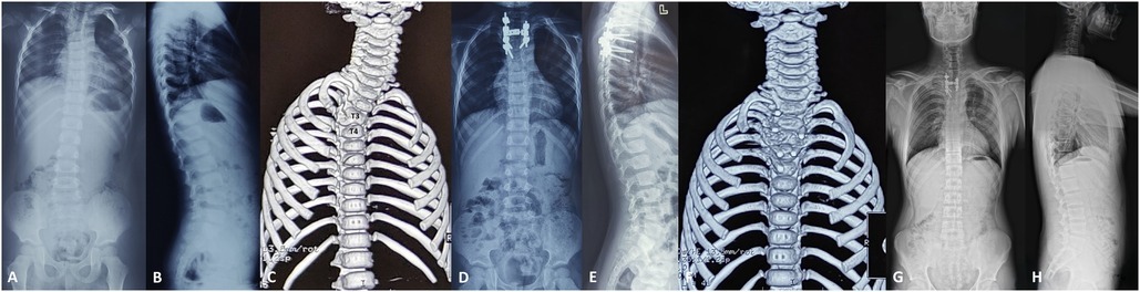 Hemivertebra on three-dimensional CT (failure of formation). Panel C shows a right T3-T4 hemivertebra in a 3-year-old; the surrounding panels are the corresponding pre-operative radiographs. Zhang C et al., Front Surg 2025;12:1473800, Fig. 2 (CC BY 4.0).