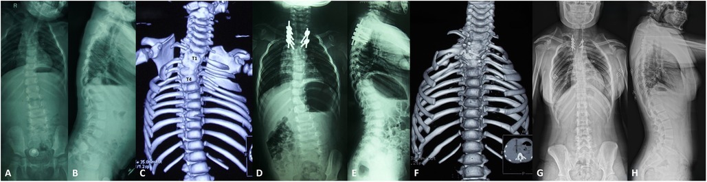 Unilateral unsegmented bar on three-dimensional CT (failure of segmentation). Panel C shows a left T1-T4 unsegmented bar in a 2-year-old - the most progressive of the pure anomalies. Zhang C et al., Front Surg 2025;12:1473800, Fig. 1 (CC BY 4.0).