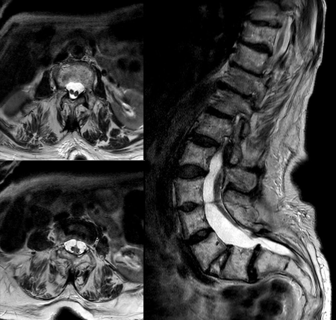 Diastematomyelia (split-cord malformation). Axial (left) and sagittal (right) T2-weighted MRI in which the cord is divided into two hemicords - the commonest intraspinal anomaly accompanying congenital scoliosis, and a reason whole-spine MRI precedes correction. Hellerhoff, Wikimedia Commons (CC BY-SA 3.0).
