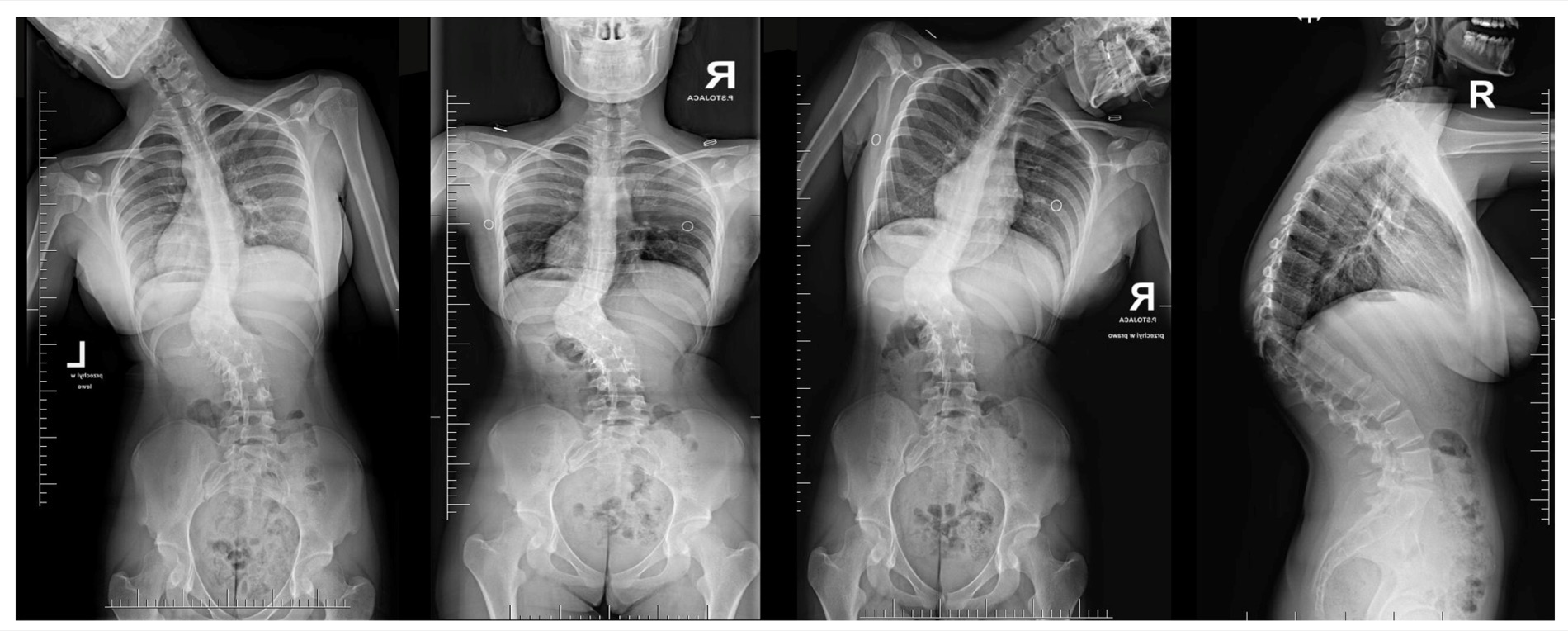 Congenital kyphosis. Standing antero-posterior, side-bending and lateral radiographs of a severe, rigid congenital kyphosis; the sharp angular kyphus is seen on the lateral (right-hand) view. Grabala P et al., Medicina (Kaunas) 2024;60:897, Fig. 2 (CC BY 4.0).