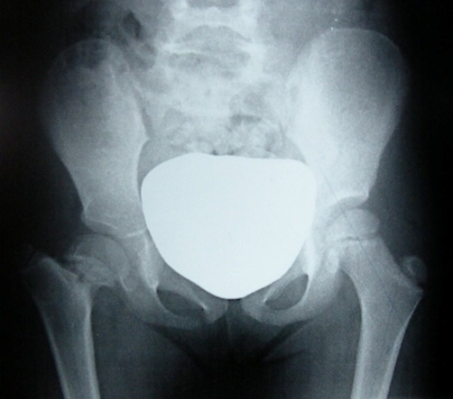 Developmental coxa vara. Antero-posterior pelvis of a child with left-sided coxa vara: the reduced neck-shaft angle, shortened neck and high greater trochanter (the central white shield is gonad protection). Mazzini JP et al., Cases Journal 2009;2:8130, Fig. 1 (CC BY 3.0).