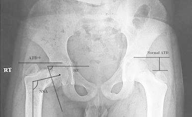 The Hilgenreiner-epiphyseal angle. Antero-posterior pelvis with the HE angle, neck-shaft angle (NSA) and articulo-trochanteric distance (ATD) drawn on the affected hip, the normal ATD shown opposite. Hefny H et al., Strategies Trauma Limb Reconstr 2013;8(3):161-167, Fig. 1 (CC BY).