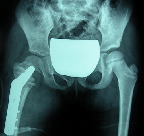 Valgus osteotomy for coxa vara. The same child after a valgus osteotomy of the left proximal femur fixed with an angled (blade) plate, with greater-trochanter epiphysiodesis; the neck-shaft angle is restored. Mazzini JP et al., Cases Journal 2009;2:8130, Fig. 3 (CC BY 3.0).