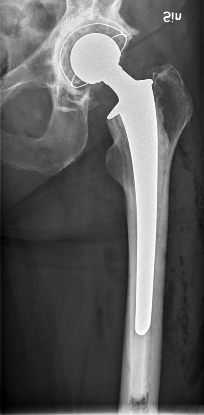 Cementless total hip arthroplasty. Postoperative AP radiograph of a porous-coated, press-fit tapered femoral stem with a modular head and a hemispherical acetabular cup. Mikael Häggström, via Wikimedia Commons (CC0).