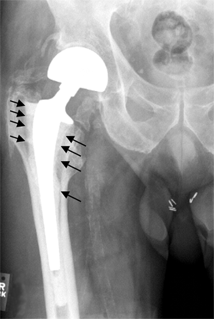 Wear-driven osteolysis (aseptic loosening). Pre-revision radiograph of a cemented femoral stem with peri-implant radiolucent osteolytic lesions (arrows) along the shaft. Shen Z et al., Arthritis Res Ther 2006;8:R70; via Wikimedia Commons, CC BY 2.0.