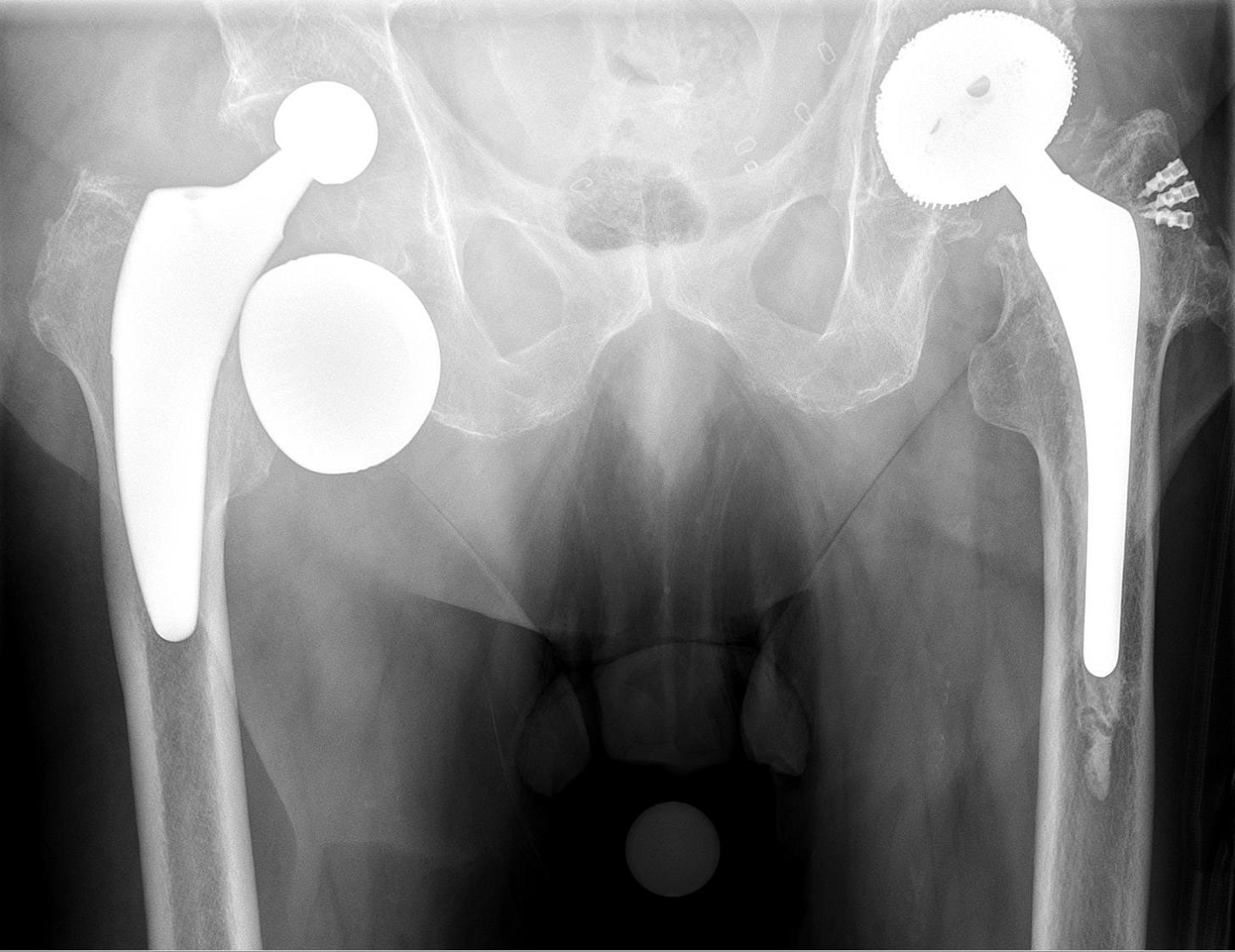Dislocated total hip replacement. AP pelvis with the right prosthetic femoral head displaced superolaterally, completely out of its acetabular cup. Hellerhoff, via Wikimedia Commons, CC BY-SA 4.0.