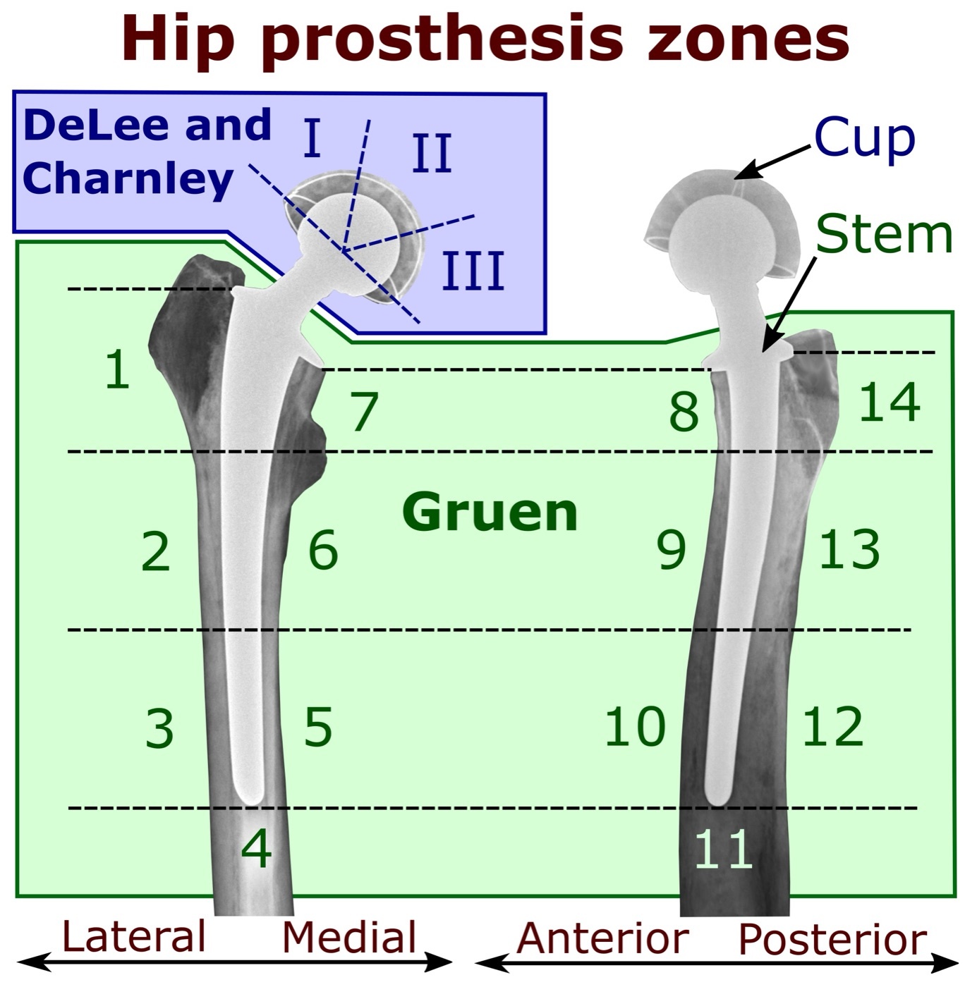 The radiographic zones for describing loosening. Hip-implant radiographs annotated with the Gruen femoral zones and the DeLee-Charnley acetabular zones (I-III), used to localise periprosthetic lucency. Mikael Häggström, via Wikimedia Commons (CC0).