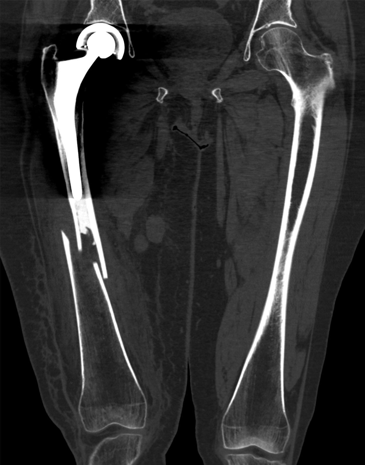 Periprosthetic femoral fracture (Vancouver type C). Coronal CT reconstruction showing an oblique femoral-shaft fracture well distal to the tip of a well-fixed stem. Hellerhoff, via Wikimedia Commons, CC BY-SA 4.0.