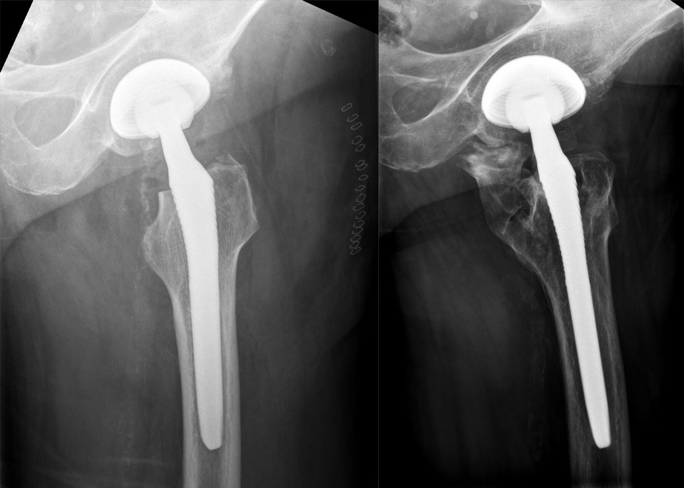 Heterotopic ossification after total hip arthroplasty. Abundant periarticular new bone around the proximal femur and greater trochanter following hip replacement (Brooker-type ossification). Hellerhoff, via Wikimedia Commons, CC BY-SA 4.0.