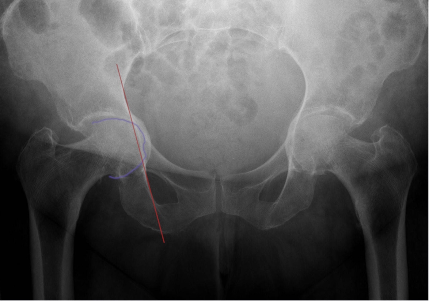 Protrusio acetabuli (a secondary-OA pattern). AP pelvis with the right femoral head migrating medial to the ilioischial line (outlined). Medial migration is the pincer/inflammatory pattern, in contrast to the superolateral migration of dysplasia. Hellerhoff, via Wikimedia Commons, CC BY-SA 4.0.