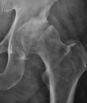 Hip osteoarthritis - the cardinal radiographic features. AP hip showing superolateral joint-space narrowing, subchondral sclerosis of the acetabular roof and marginal osteophytes. Ruiz Santiago F et al., Radiol Res Pract 2016; via Wikimedia Commons, CC BY 4.0.