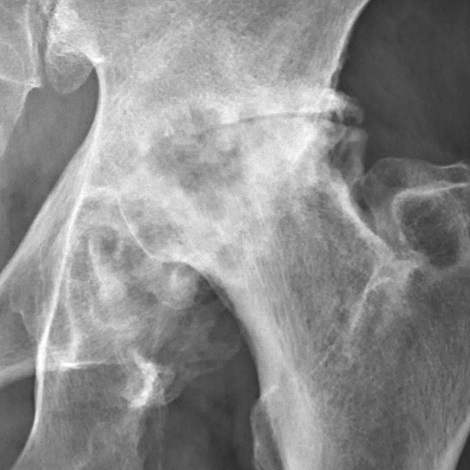 Severe (Tönnis grade 3) coxarthrosis. Near-complete loss of the superior joint space, dense sclerosis, large osteophytes and subchondral cysts. Mikael Häggström, via Wikimedia Commons (CC0).
