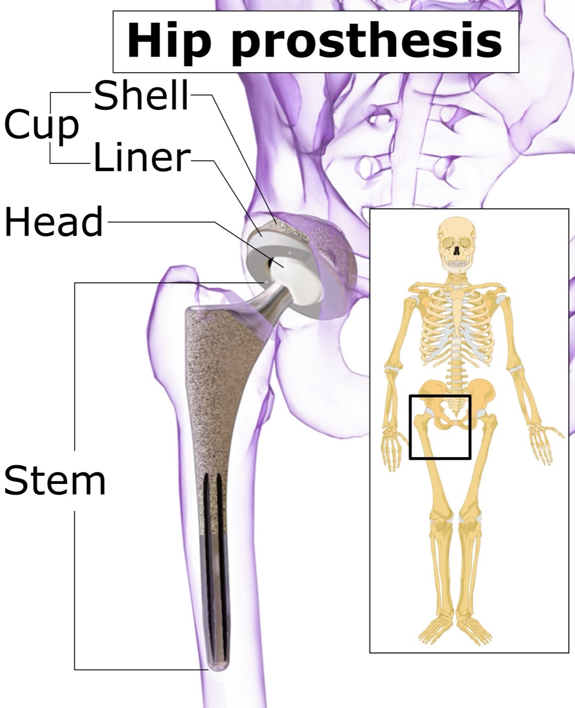 The components of a total hip replacement. The acetabular cup (shell and liner), the modular femoral head, and the stem, shown on a pelvis outline. Mikael Häggström, via Wikimedia Commons, CC BY-SA 4.0.