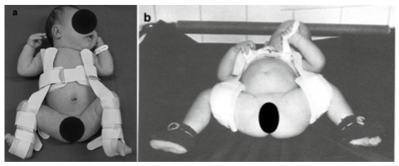 Pavlik harness on an infant. Panel (a): the harness applied - the anterior chest strap with the leg stirrups holding the hips in flexion and gentle abduction (the “human position”). Panel (b): a Daimler bandage, for comparison. Faces are anonymised in the source. (Gahleitner et al., Medicina (Kaunas) 2022;58:206, Fig. 1; CC BY 4.0.)