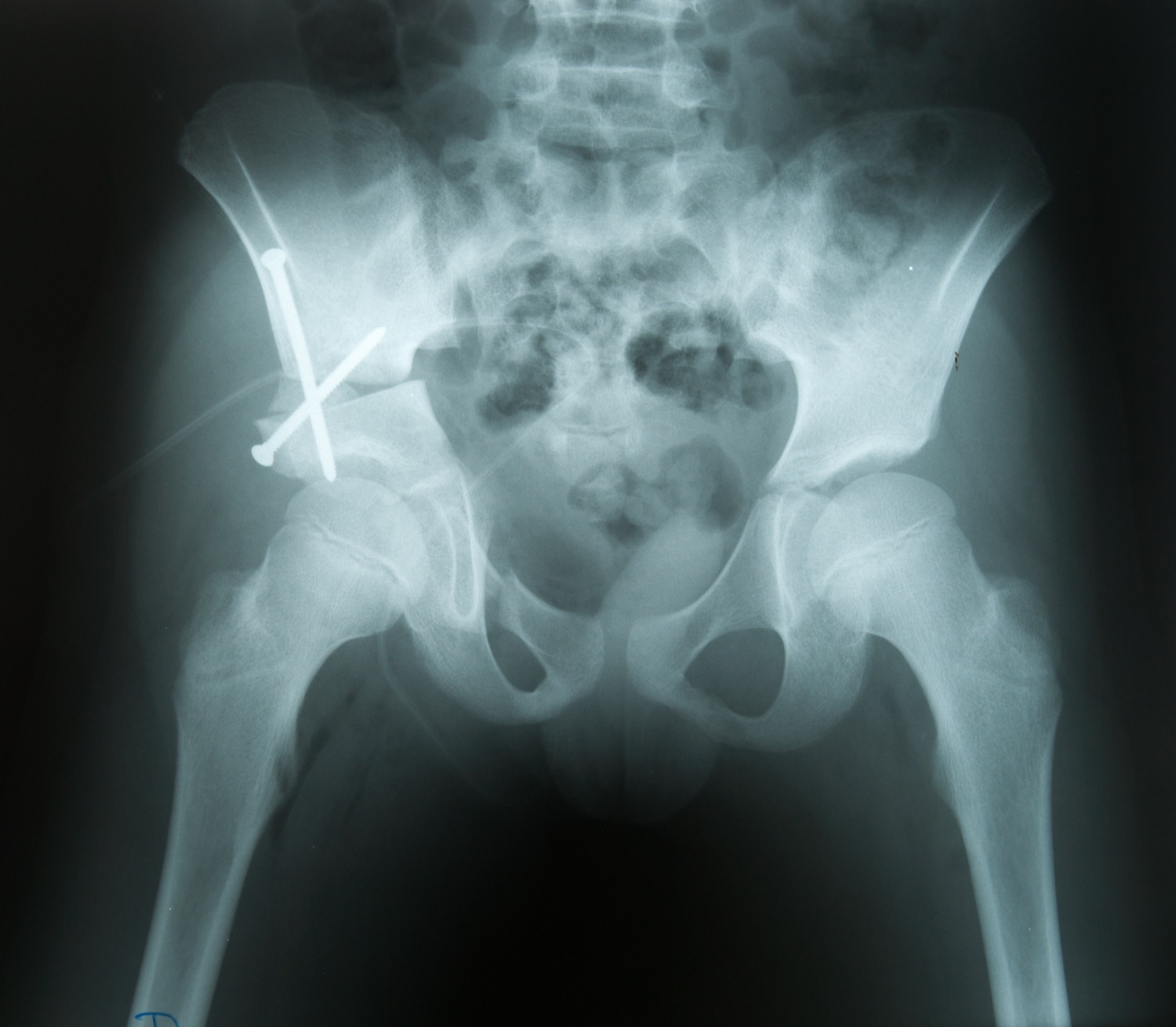 Post-operative antero-posterior pelvis after a pelvic (innominate) osteotomy of the right hip for DDH, with K-wire and screw fixation across the right ilium; the right femoral head is now better covered. (Wikimedia Commons, “Login jetable”; CC0.)