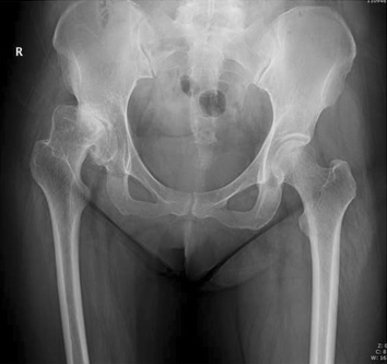 Antero-posterior pelvis of an adult with residual hip dysplasia (right hip, Crowe II): a shallow acetabulum with a steep roof and an incompletely covered, subluxated femoral head - the substrate for early secondary osteoarthritis. (Zhen et al., BMC Musculoskelet Disord 2017;18:142; CC BY 4.0, via Wikimedia Commons.)