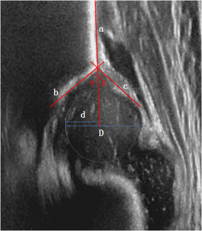 Coronal infant hip ultrasound, normal Graf type I, with the Graf construction: the baseline (a), the bony-roof line (b) and the cartilage-roof line (c) give the α (bony) and β (cartilaginous) angles; d/D mark femoral-head coverage. The acetabulum is deep and the head well covered. (Liu et al., Front Pediatr 2022;10:914545, Fig. 1; CC BY 4.0.)