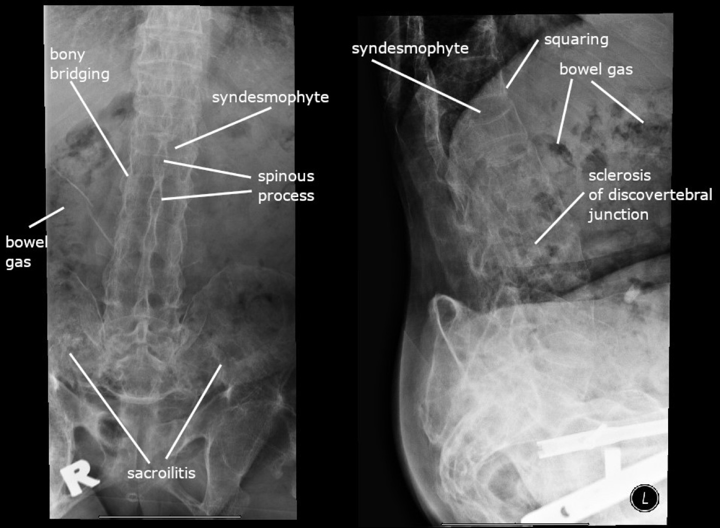 The radiographic signs of the ankylosing-spondylitis spine. Annotated lumbosacral radiographs: syndesmophytes, bony bridging, squaring of the vertebral bodies, discovertebral sclerosis and sacroiliitis. Wikimedia Commons, CC BY-SA 4.0.