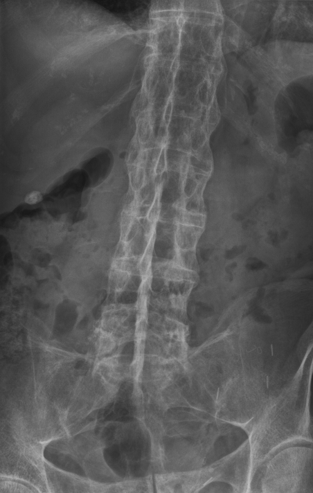 “Bamboo spine.” Radiograph showing continuous marginal syndesmophytes bridging adjacent vertebrae in advanced ankylosing spondylitis. Stevenfruitsmaak, Wikimedia Commons, CC BY-SA 3.0.