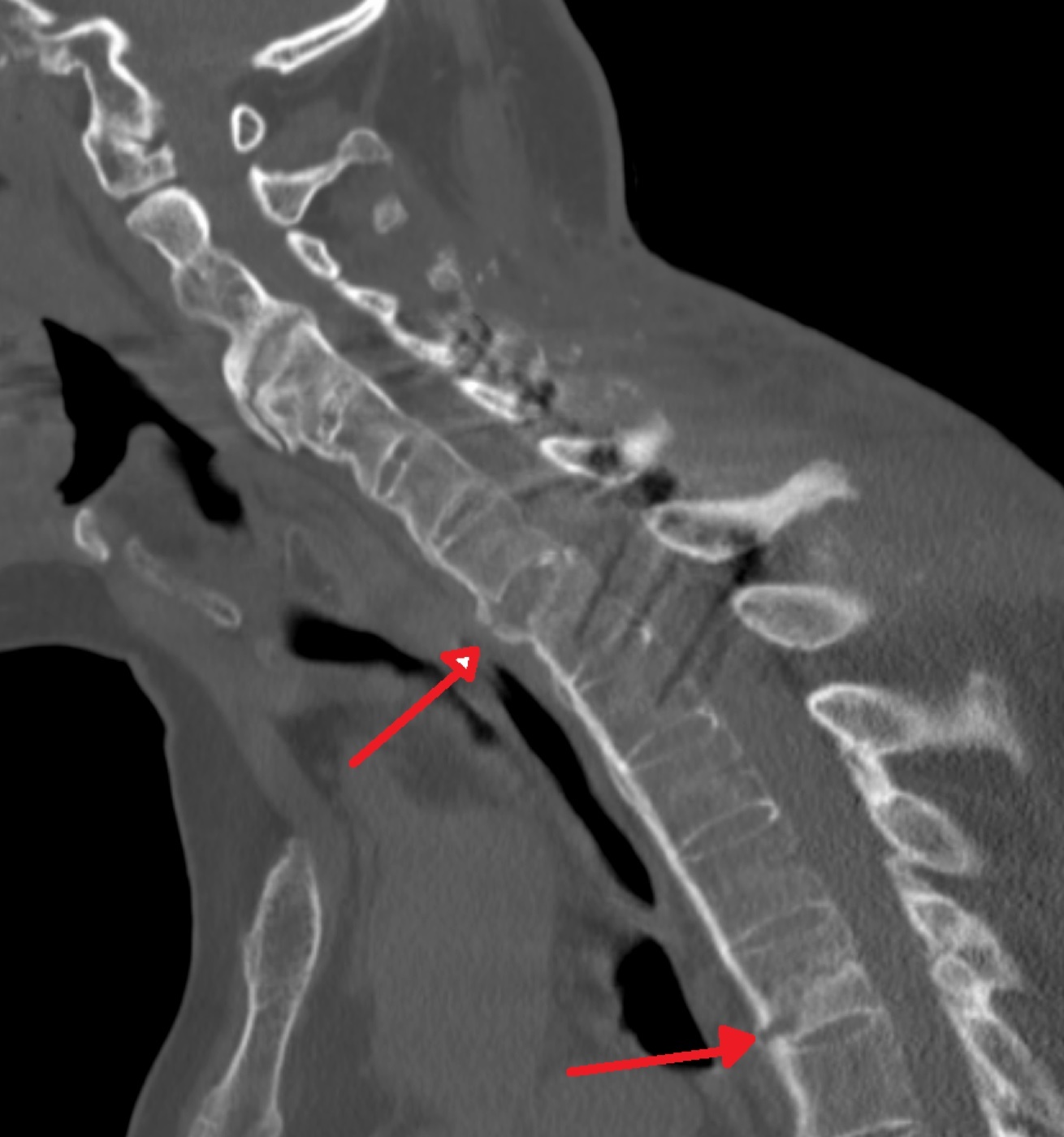 The unstable fracture of the ankylosed spine. Sagittal CT showing two transverse three-column fractures (arrows, C7 and T5) through a bamboo spine. James Heilman MD, Wikimedia Commons, CC BY-SA 4.0.
