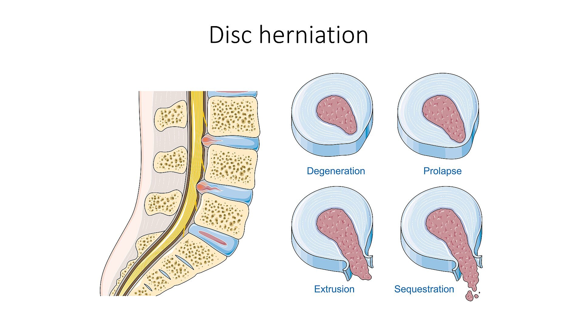 Disc herniation grades. Sagittal view (left) and axial panels showing degeneration, prolapse (protrusion), extrusion and sequestration. Laboratoires Servier, SMART Servier Medical Art, Wikimedia Commons, CC BY-SA 3.0.