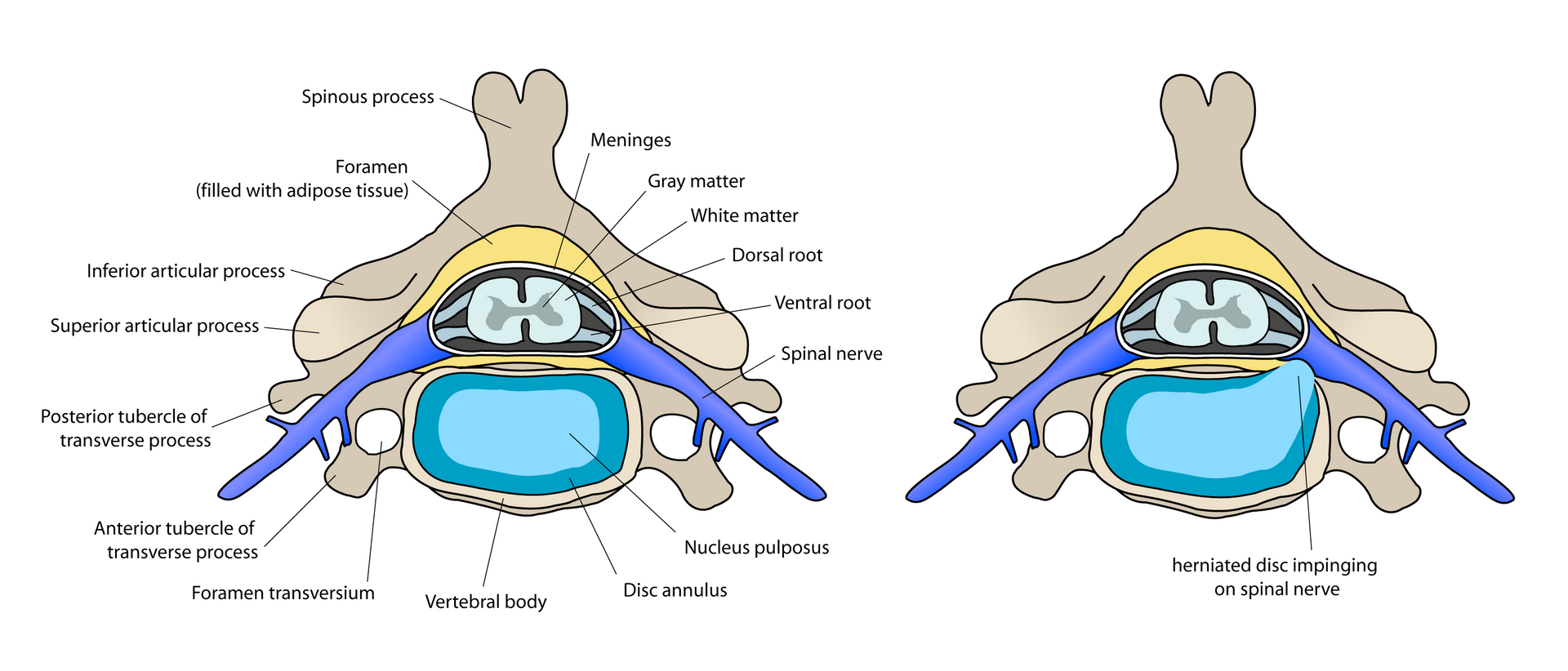 Cervical disc and the radiculopathy mechanism. Axial diagram: normal disc anatomy (left) and a herniated disc impinging on the spinal nerve root (right). debivort, Wikimedia Commons, CC BY-SA 3.0.