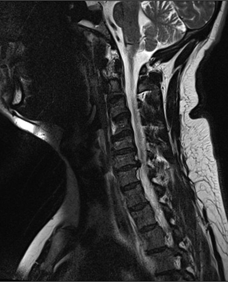 Cervical disc herniation. Sagittal T2 MRI showing a C6-C7 disc herniation indenting the cord/thecal sac. Wikimedia Commons, CC BY-SA 3.0.