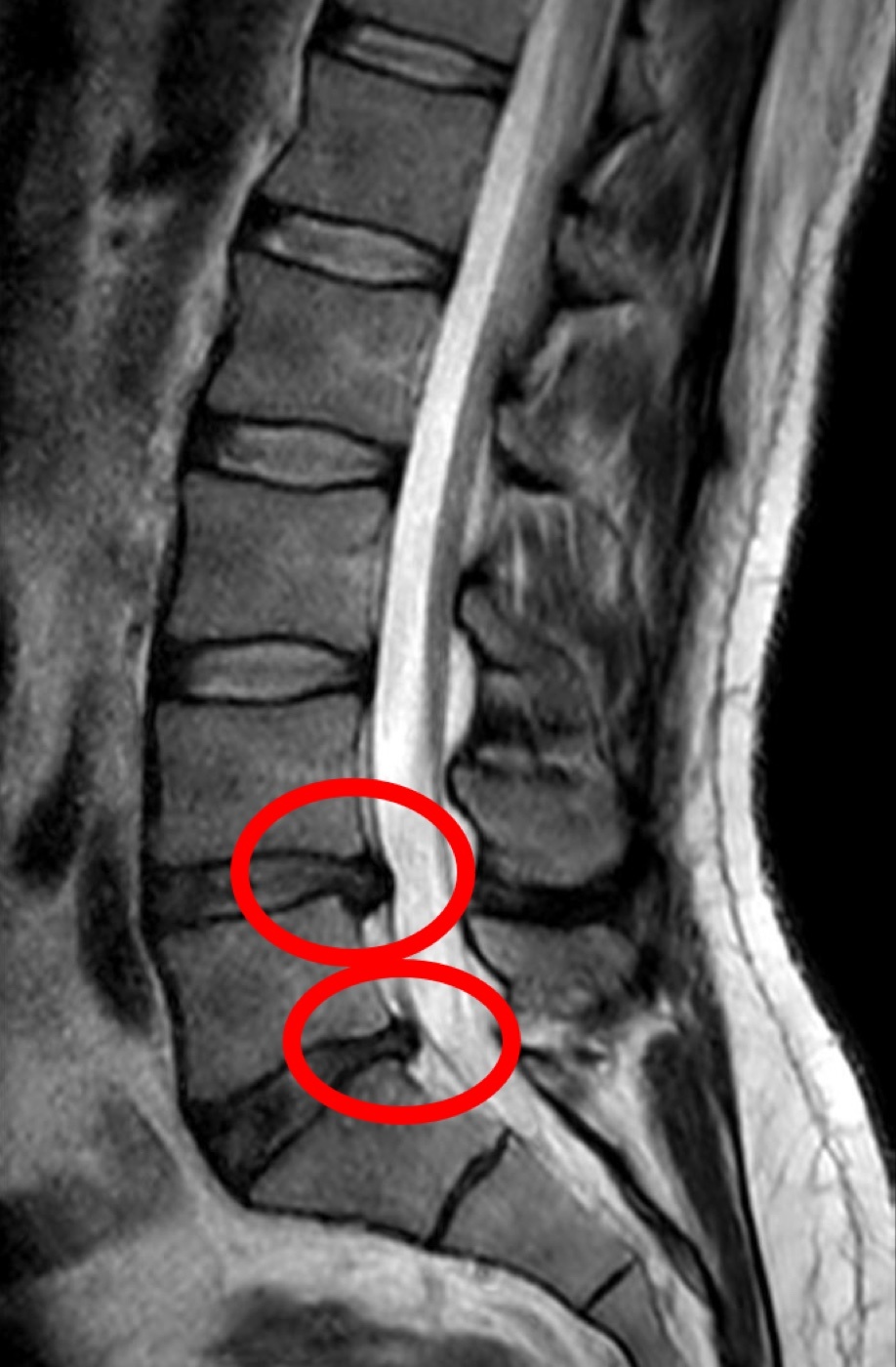 Lumbar disc herniation. Sagittal T2 MRI: a left paramedian L4-L5 herniation (circled) compressing the traversing L5 root. Miguel Tremblay, Wikimedia Commons, CC0.