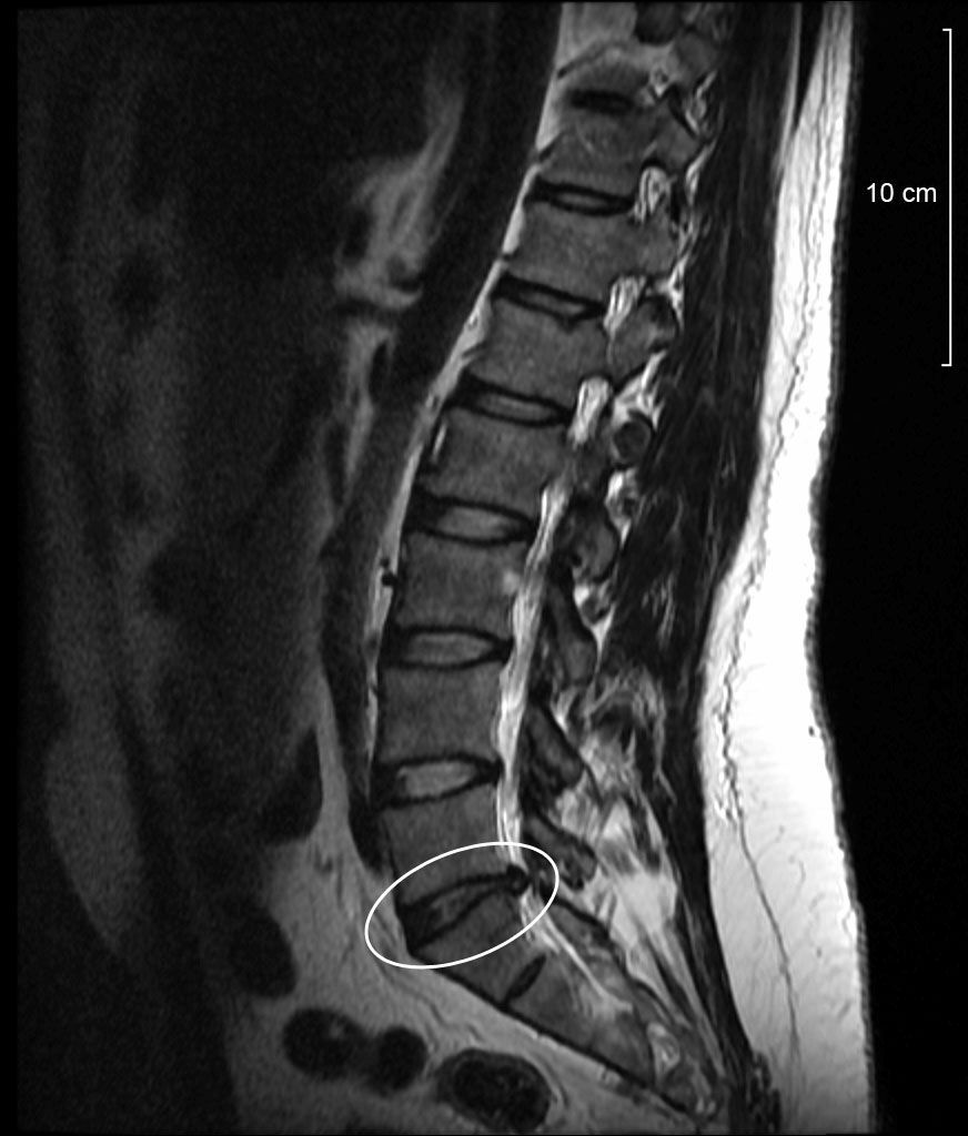 Lumbar disc protrusion. Sagittal T2 MRI with a focal lower-lumbar disc protrusion (circled) compressing the nerve root. Wikimedia Commons, public domain.