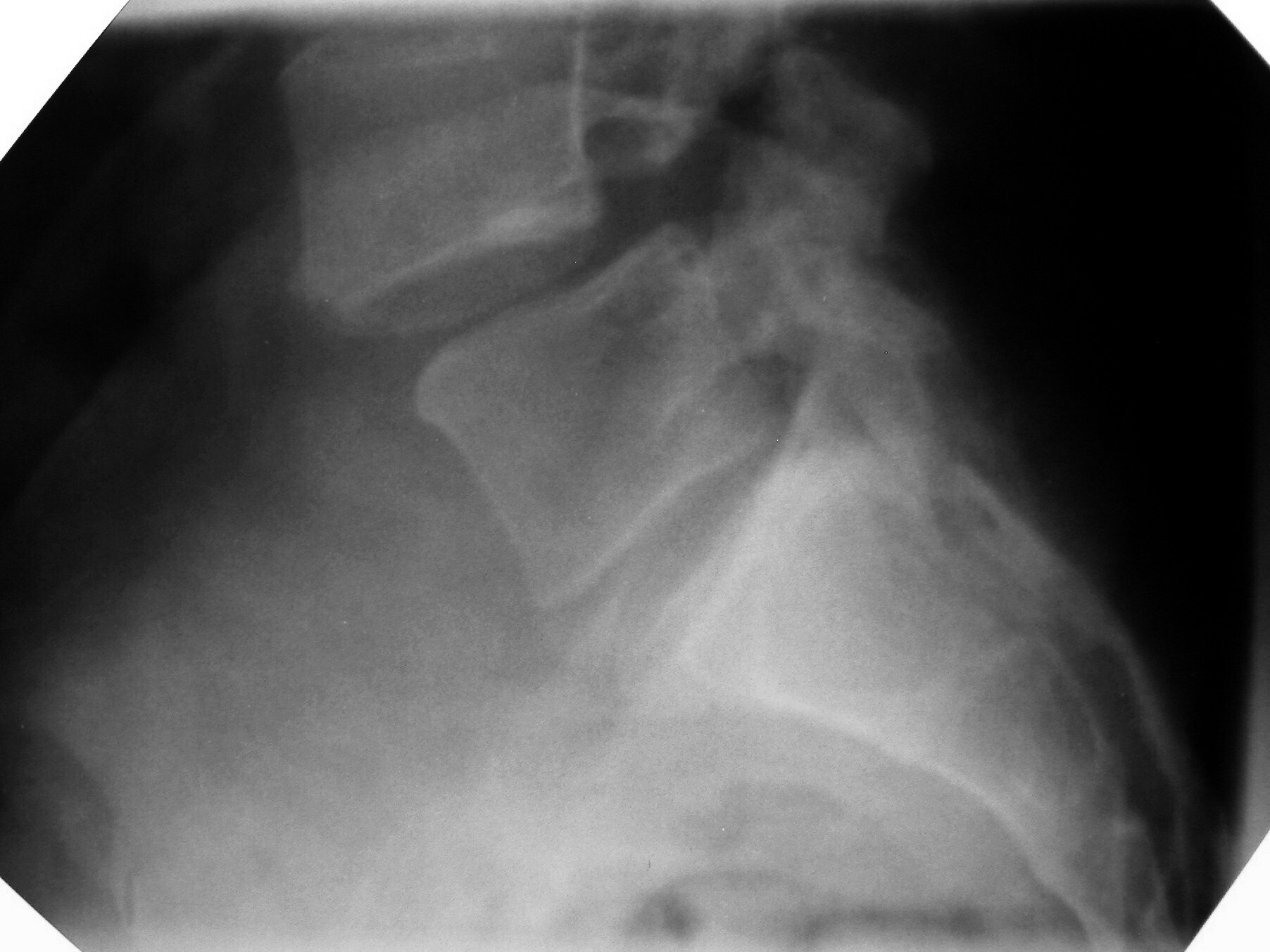 Spondylolisthesis. Lateral radiograph: a high-grade forward slip of L5 on S1. Wikimedia Commons, CC BY-SA 3.0.