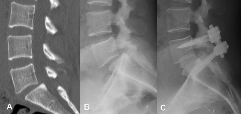 Spondylolisthesis and its fusion. (A) Sagittal CT of the slip, (B) standing lateral radiograph, (C) post-operative pedicle-screw fixation and fusion. Donnally, StatPearls / Wikimedia Commons, CC BY 4.0.